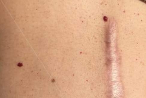 keloid scar